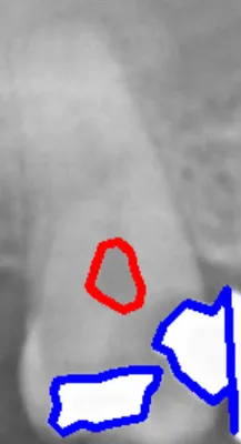 AugmenTory Dental RoI Tooth Crop